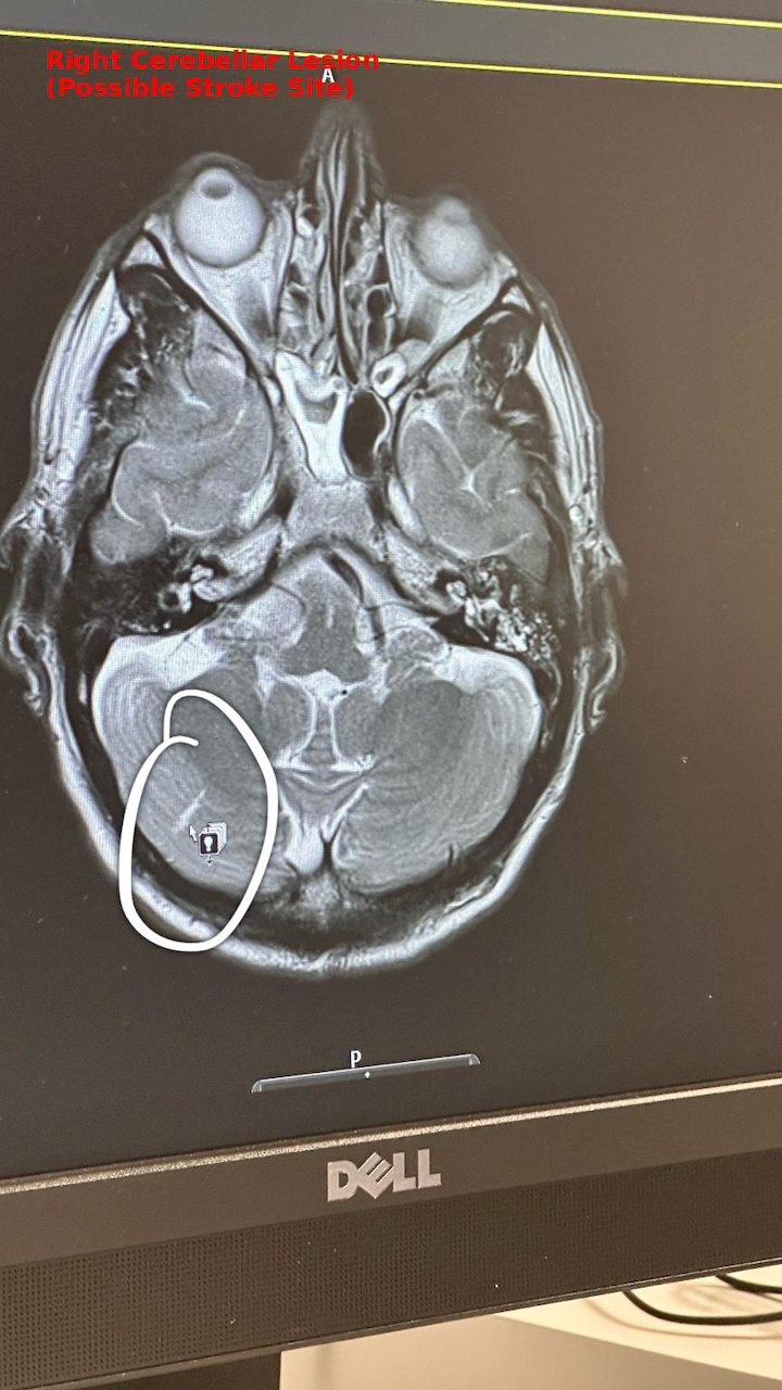 Cerebellar Lesion MRI