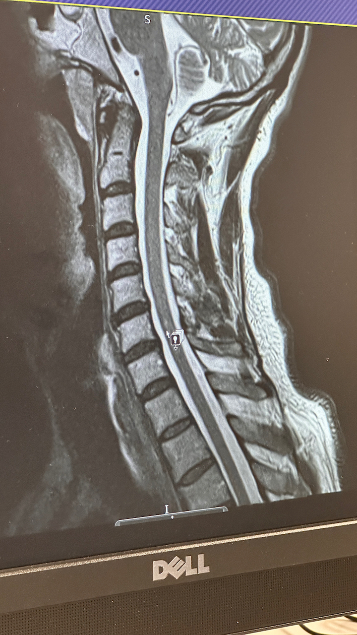 Spinal Cord Lesion MRI